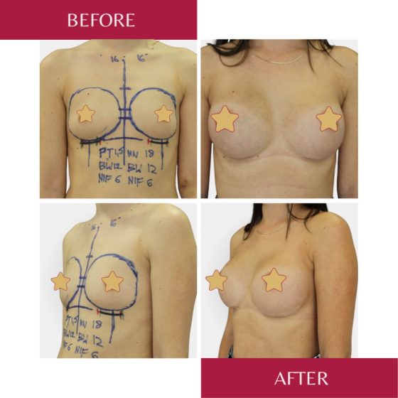 plastic surgery in Poland